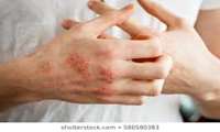 Use Glycerin-Containing Soaps to Prevent Eczema and Dry Skin